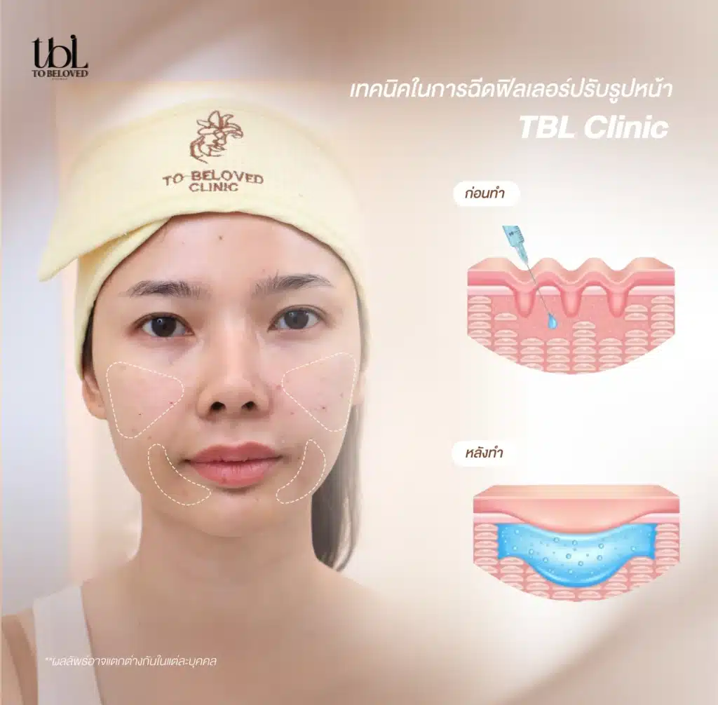 ฟิลเลอร์ปรับรูปหน้า