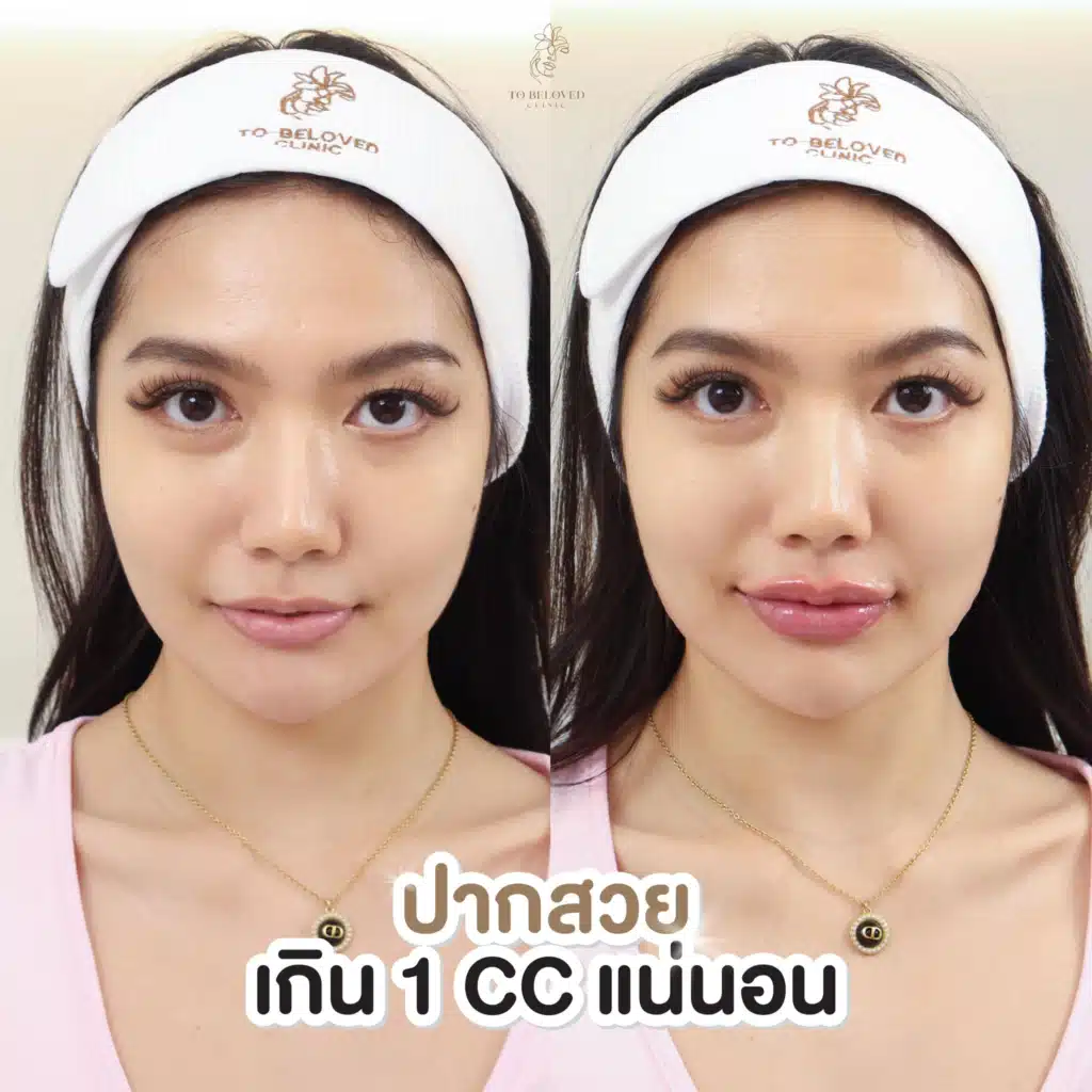 รีวิวฉีดฟิลเลอร์ปากที่ TBL Clinic
