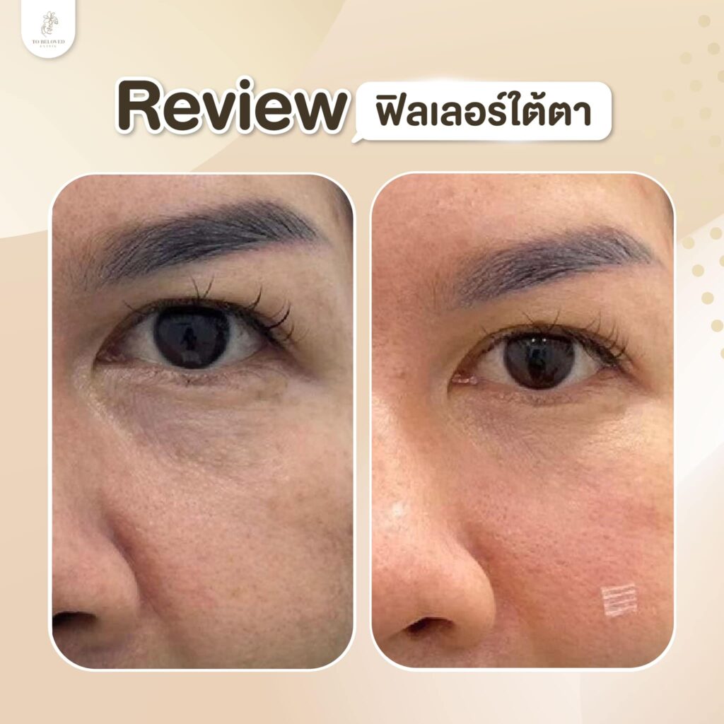 ฉีดฟิลเลอร์