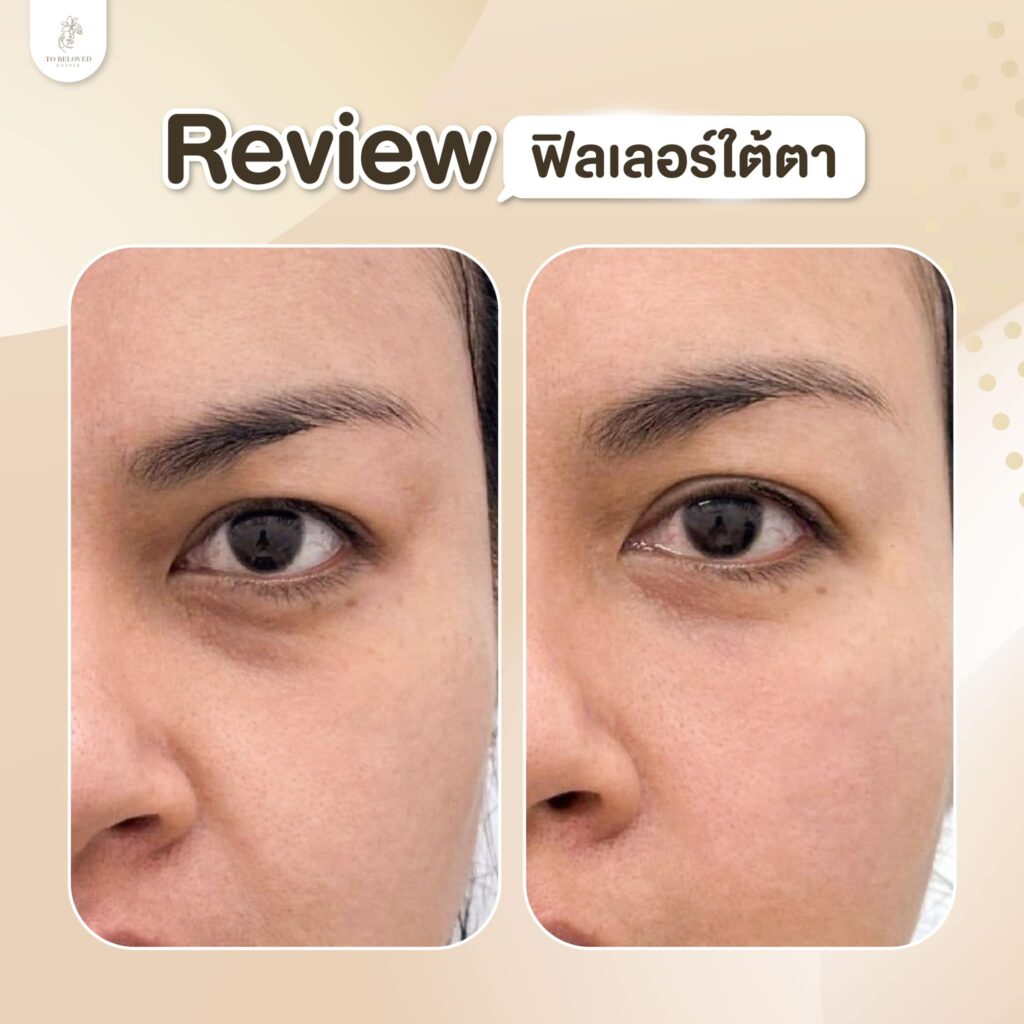 ฉีดฟิลเลอร์
