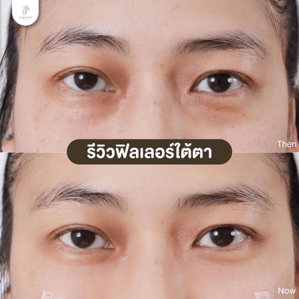 รีวิวฟิลเลอร์ใต้ตาที่ TBL Clinic