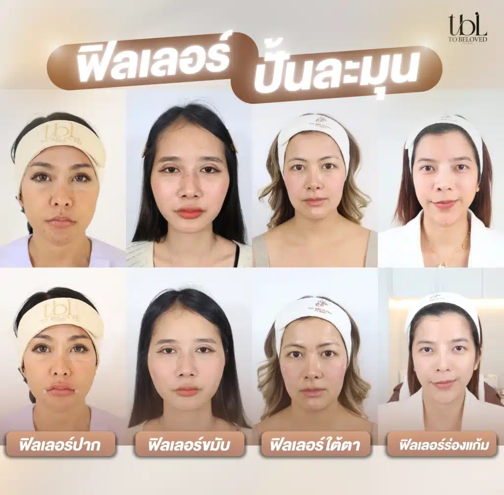 ฟิลเลอร์ปรับรูปหน้า