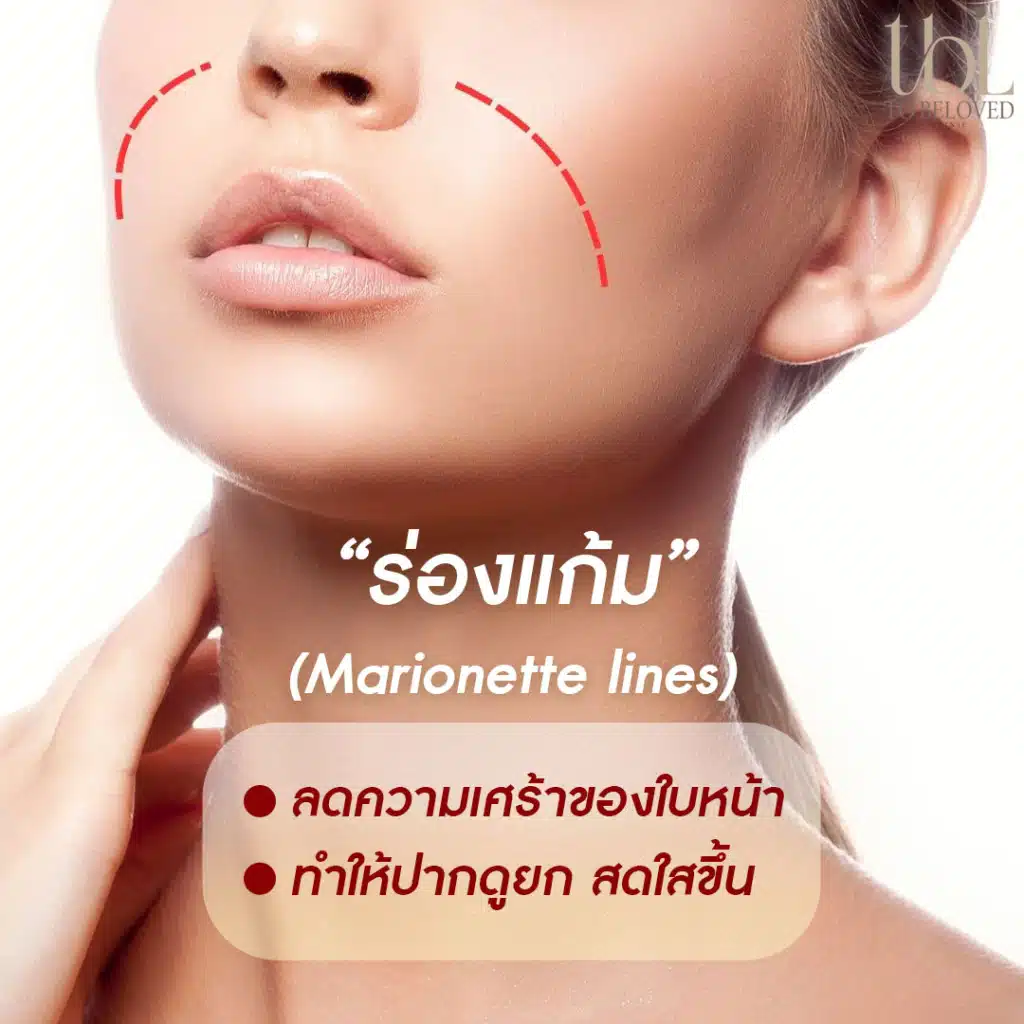 ฟิลเลอร์ร่องแก้ม