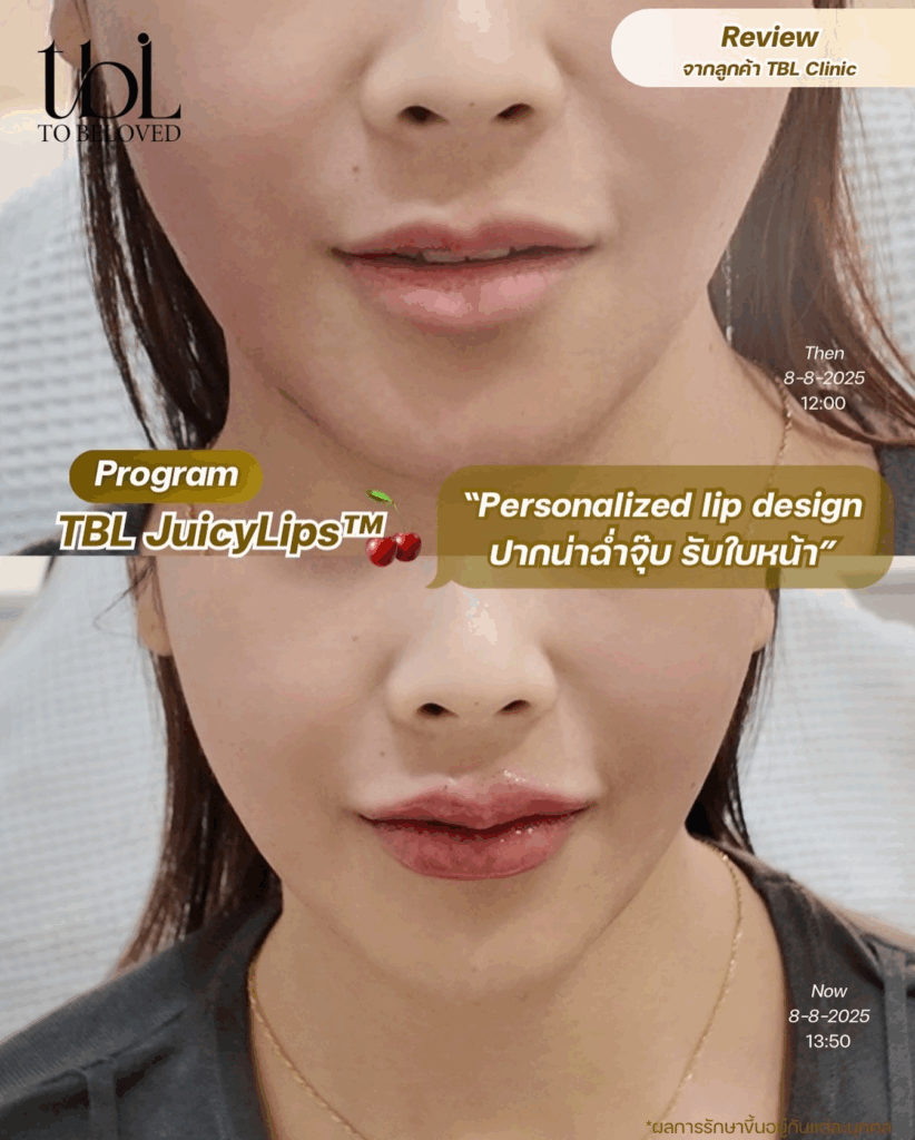 ฟิลเลอร์