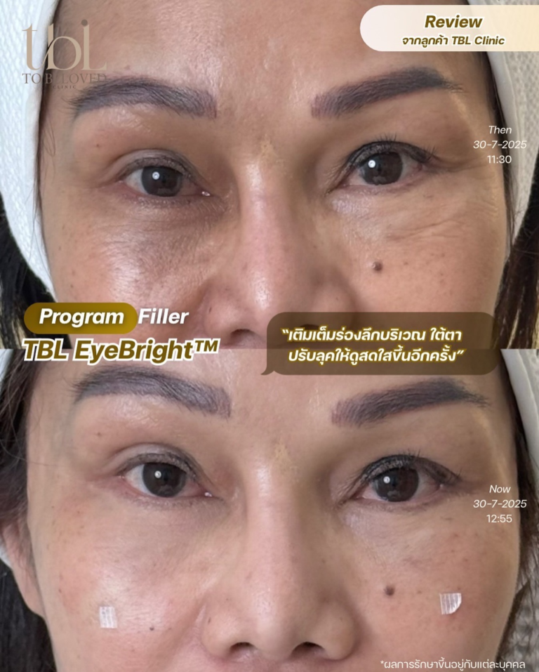 ฉีดฟิลเลอร์ใต้ตา