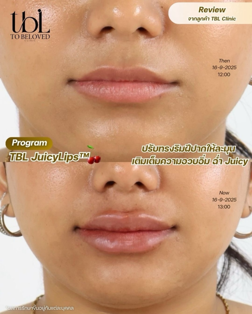 ฟิลเลอร์ปาก