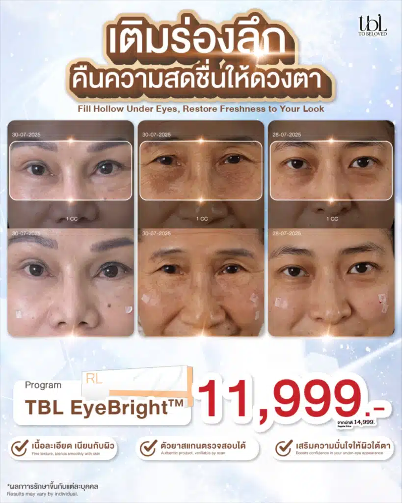 ฉีดฟิลเลอร์ใต้ตา