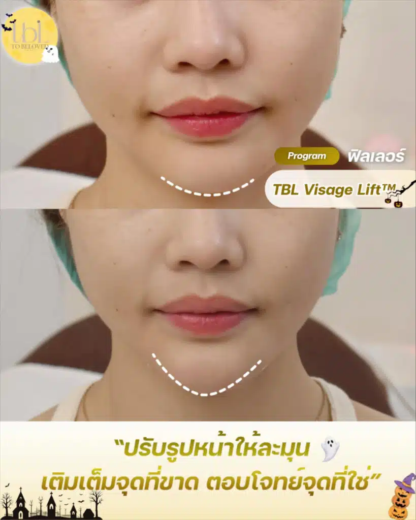 ฟิลเลอร์คาง