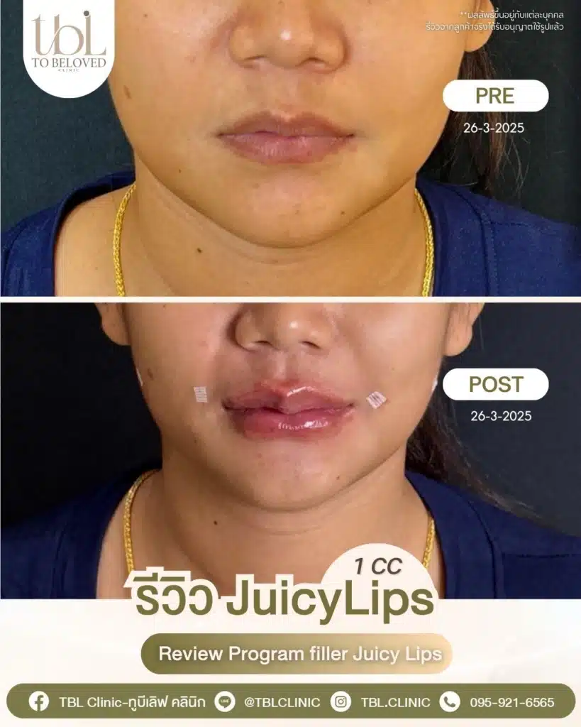 รีวิวฉีดปาก TBL Clinic