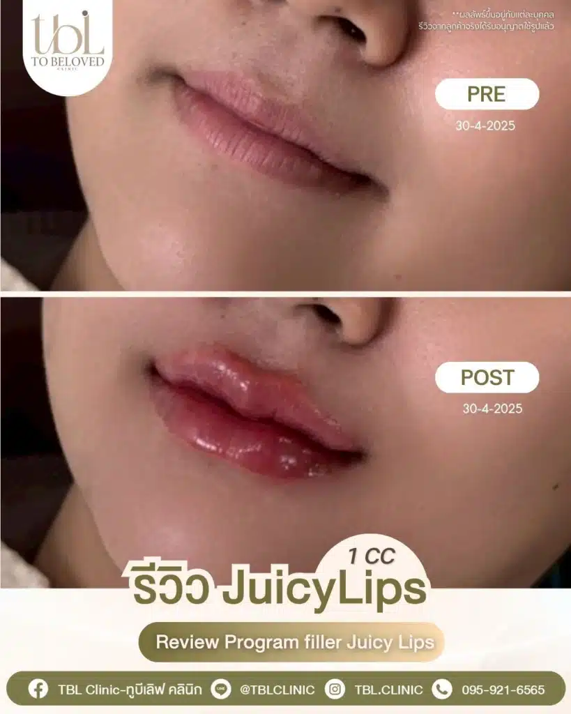 รีวิวฉีดปาก TBL Clinic