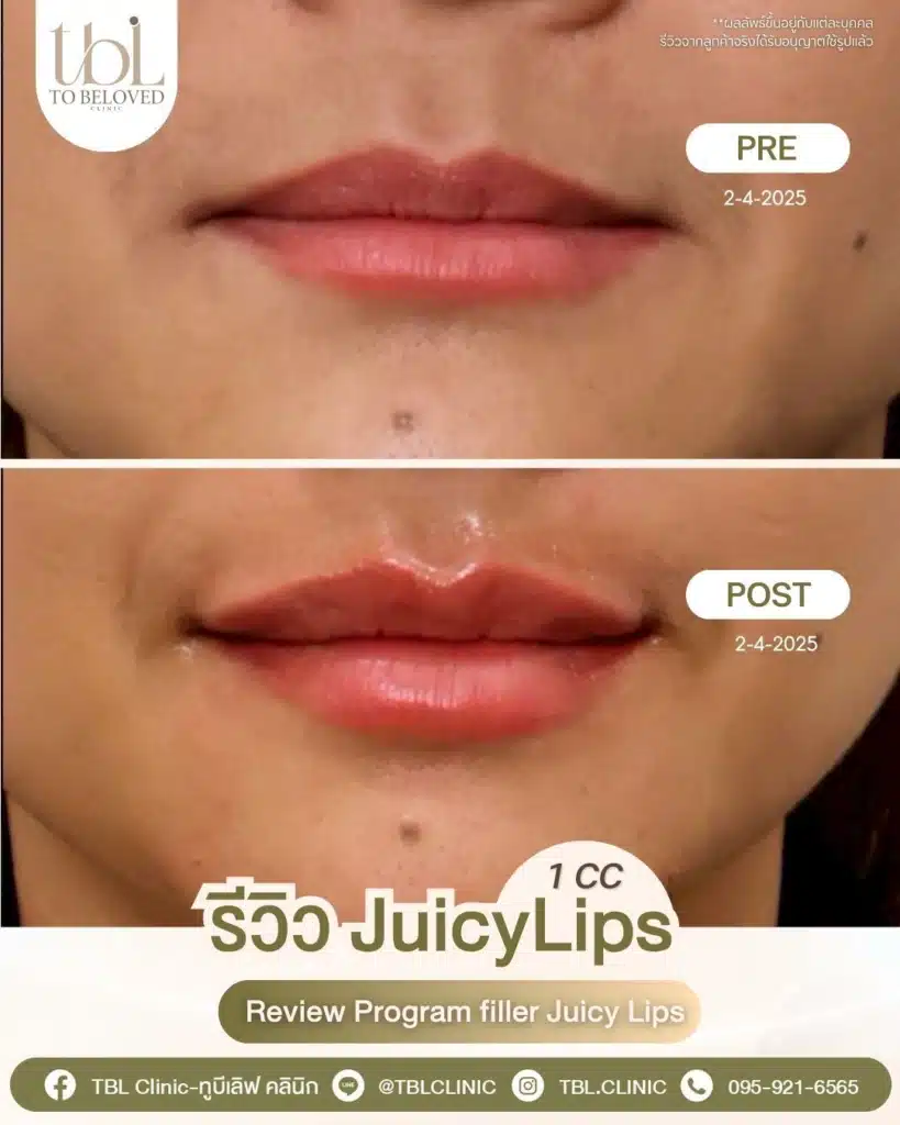 รีวิวฉีดปาก TBL Clinic