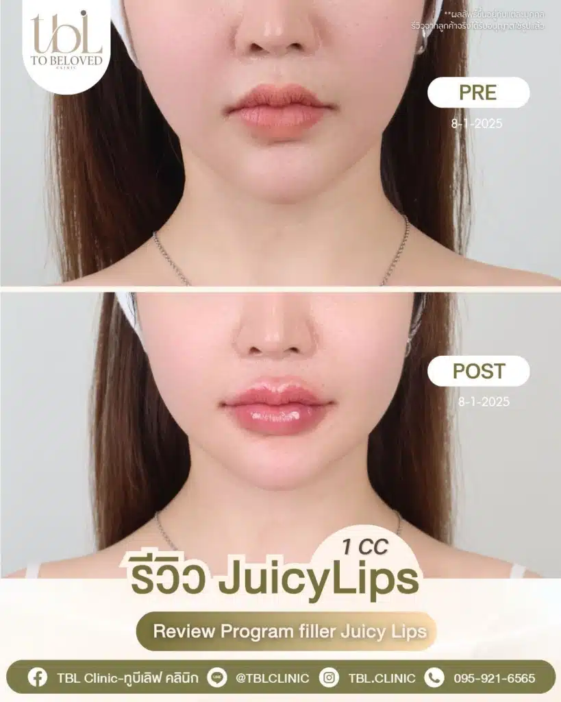 รีวิวฉีดปาก TBL Clinic