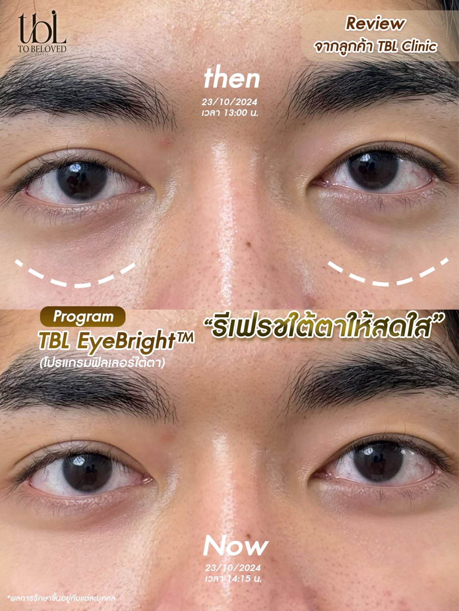 รีวิวฉีดฟิลเลอร์