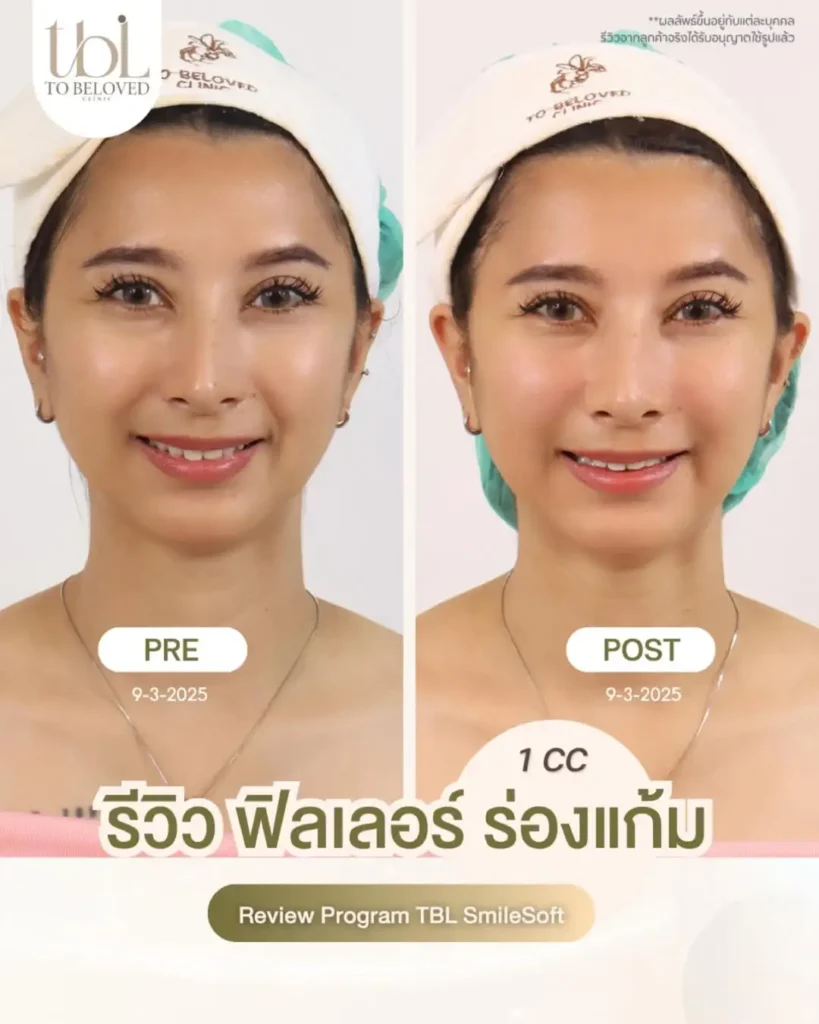 ฟิลเลอร์ร่องแก้ม