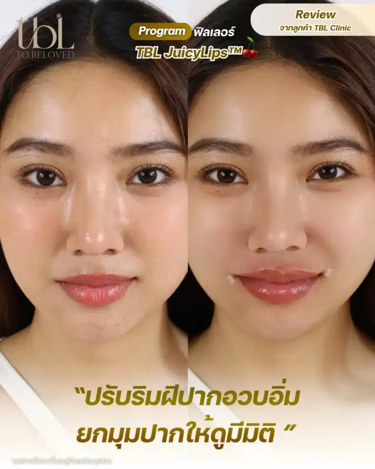 ฉีดฟิลเลอร์