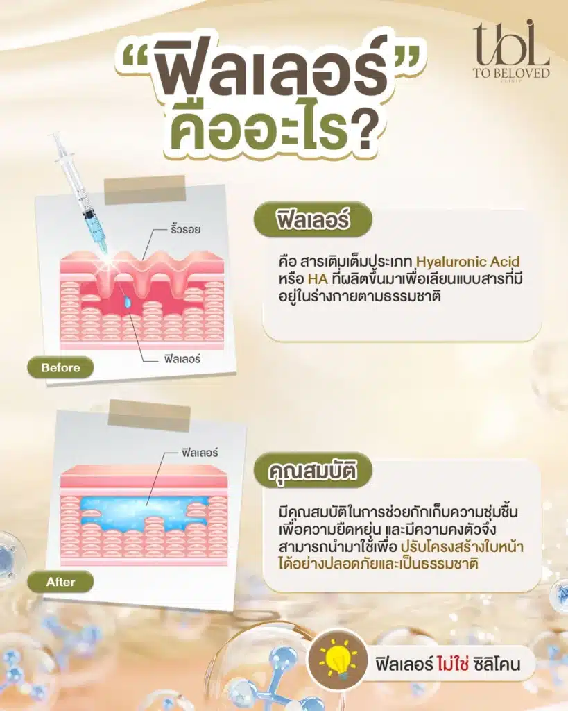 ฟิลเลอร์ คืออะไร