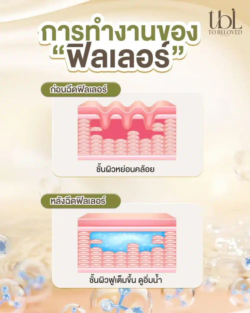 ฟิลเลอร์