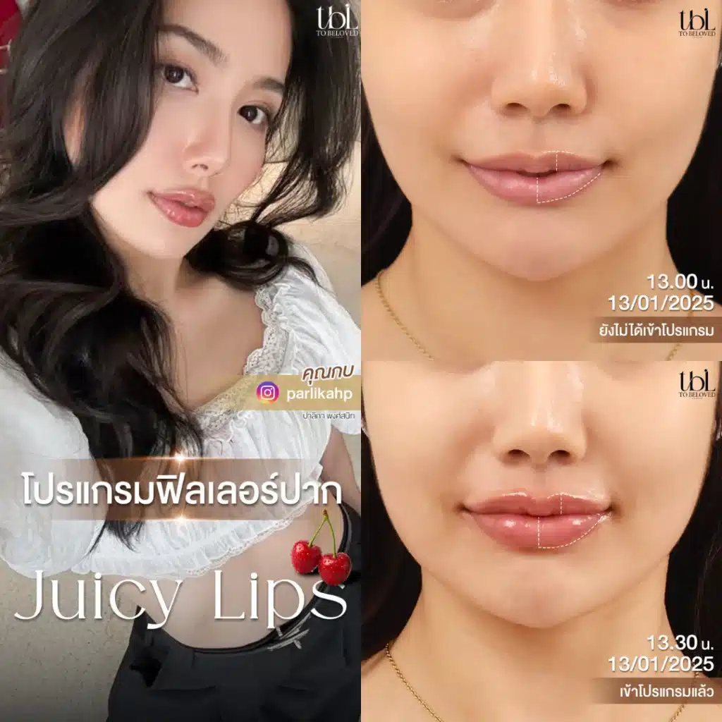 ฟิลเลอร์ปาก