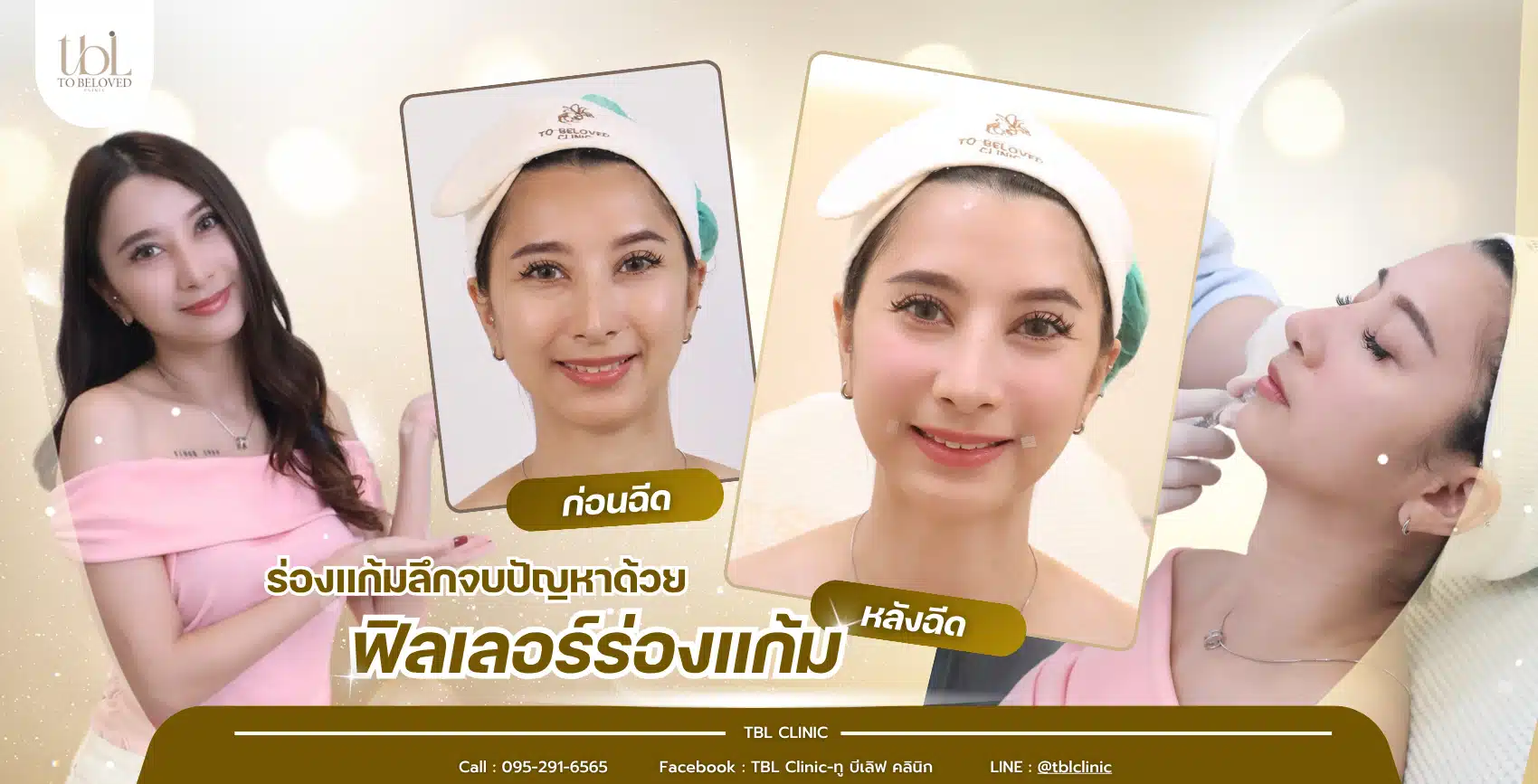 ฟิลเลอร์ร่องแก้ม