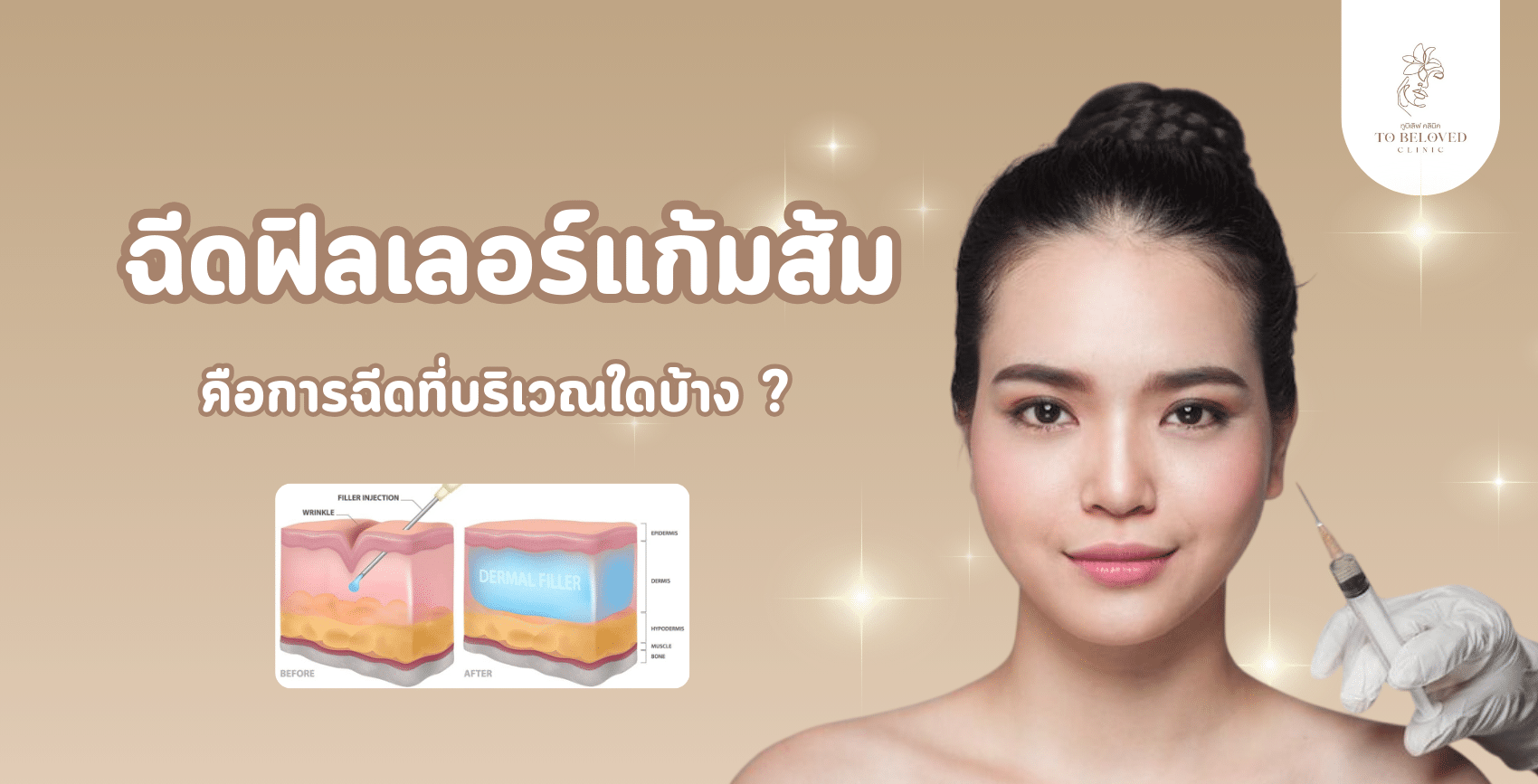 ฉีดฟิลเลอร์แก้มส้ม คือการฉีดที่บริเวณใดบ้าง