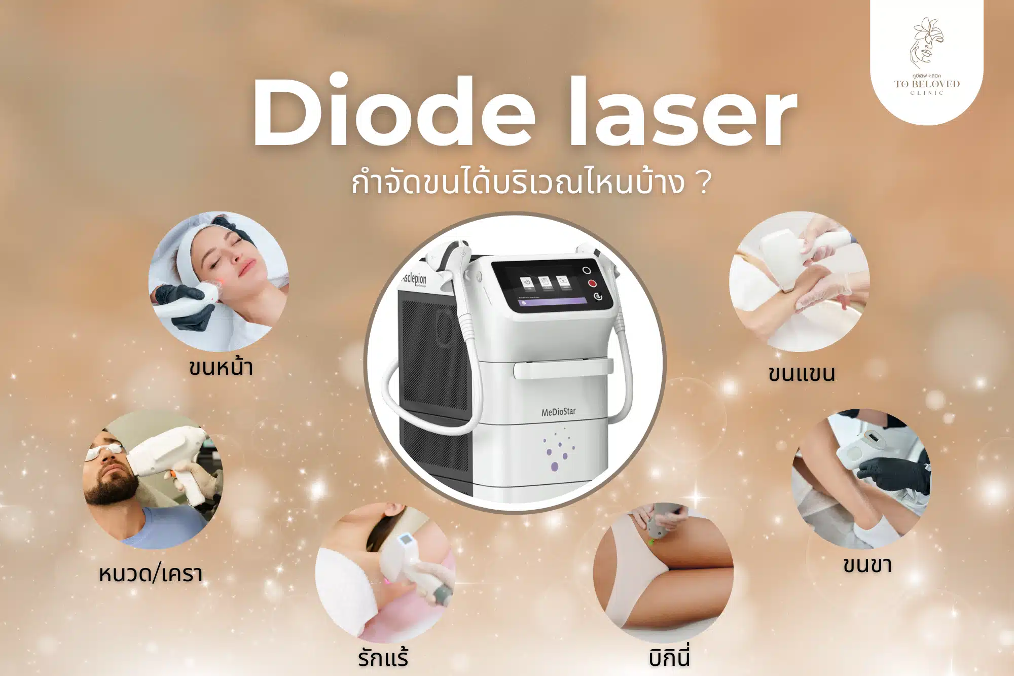 Diode laser กำจัดขนส่วนไหนได้บ้าง
