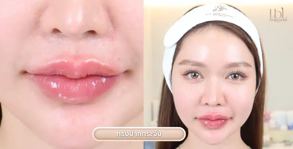 ทรงฉีดปากกระจับ