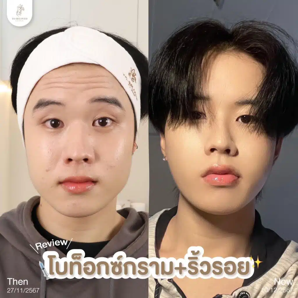 รีวิวฉีดโบท็อก