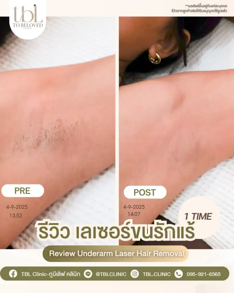 รีวิว หลังเลเซอร์รักแร้