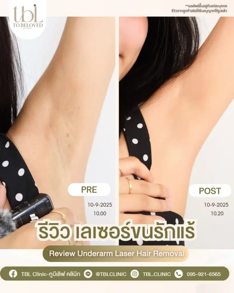 เลเซอร์ขนรักแร้