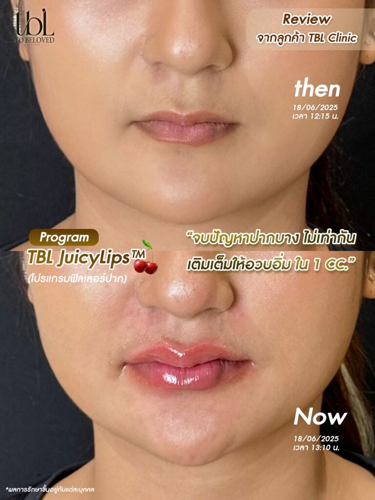 รีวิวฉีดปาก