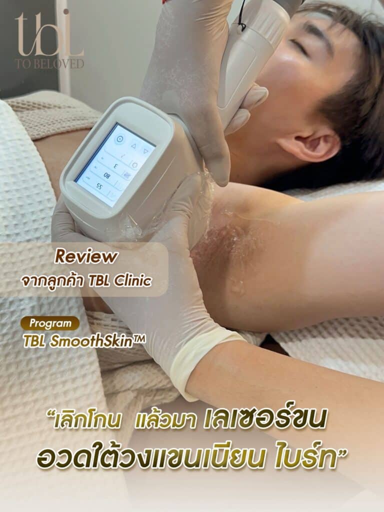 รีวิวเลเซอร์รักแร้