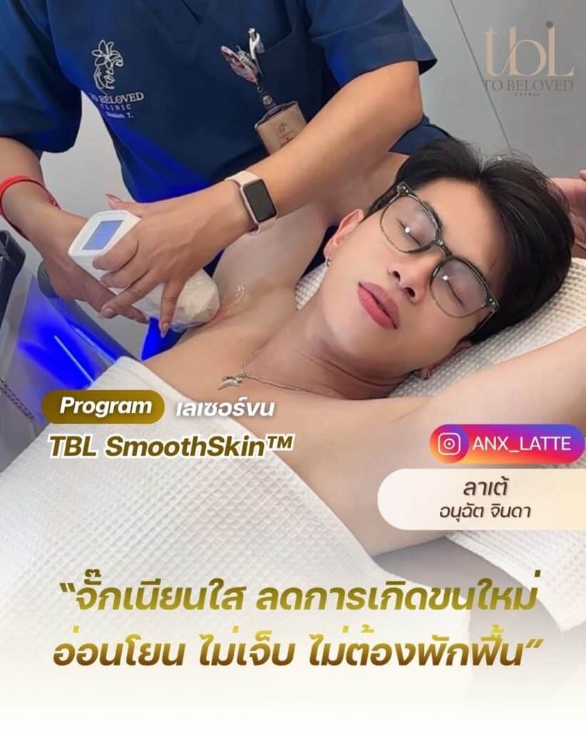รีวิวเลเซอร์รักแร้