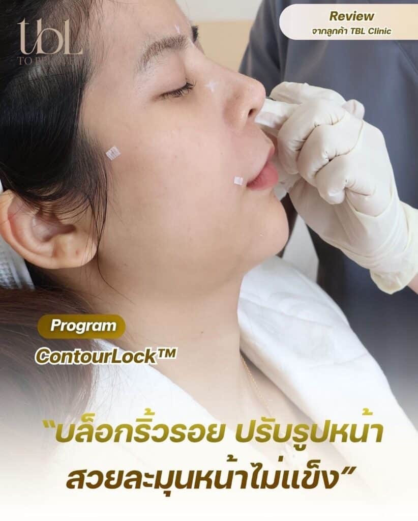 รีวิวฉีกโบท็อกลิฟต์กรอบหน้า