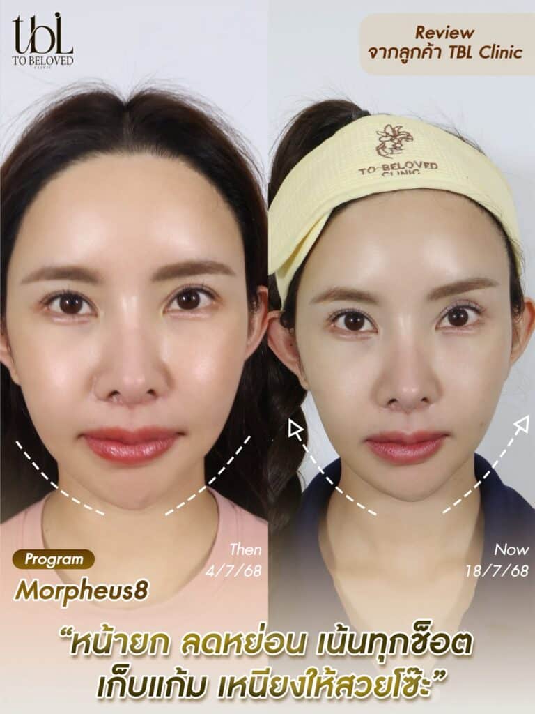 รีวิวโปรแกรมยกกระชับใบหน้า