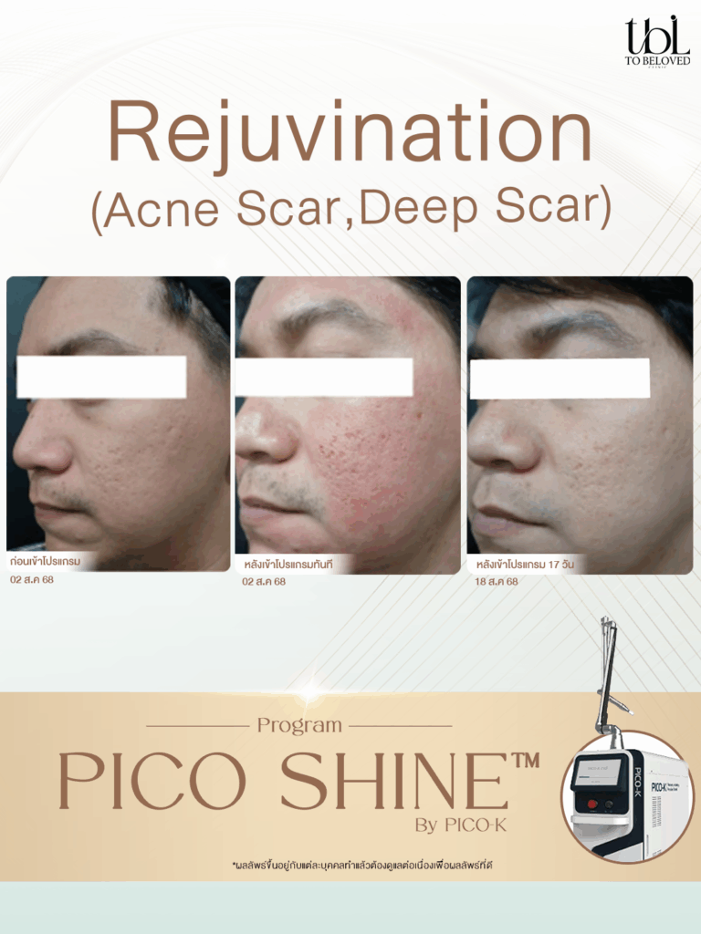 รีวิว pico