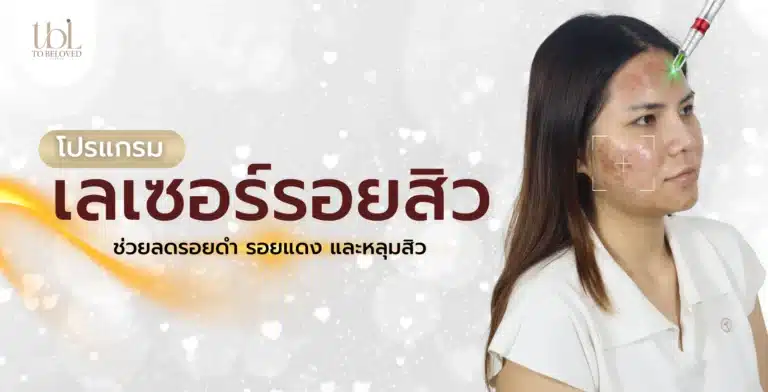 เลเซอร์รอยสิว