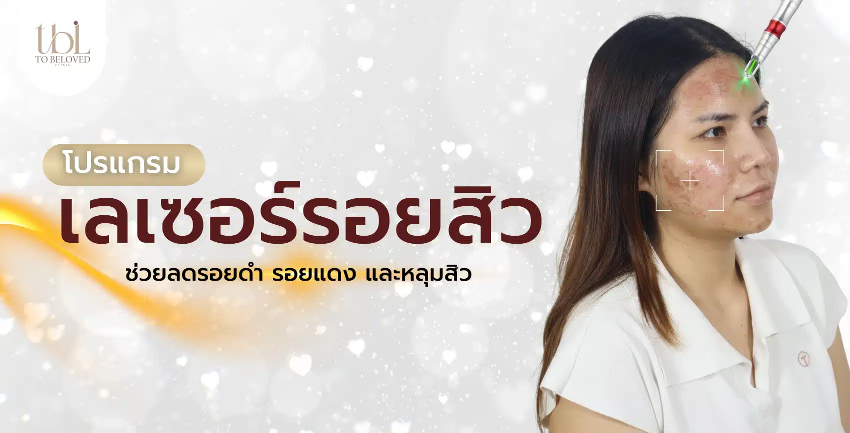 เลเซอร์รอยสิว เลเซอร์รอยสิว