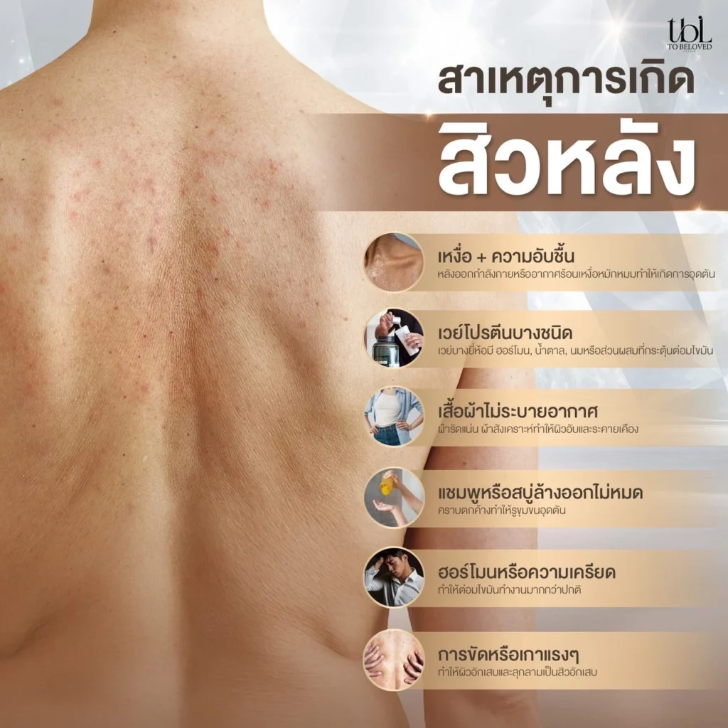 เลเซอร์รอยสิวที่หลัง