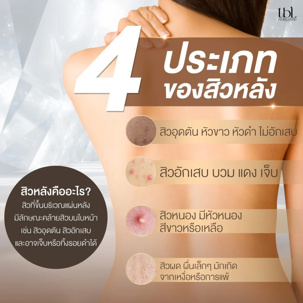 เลเซอร์รอยสิวที่หลัง