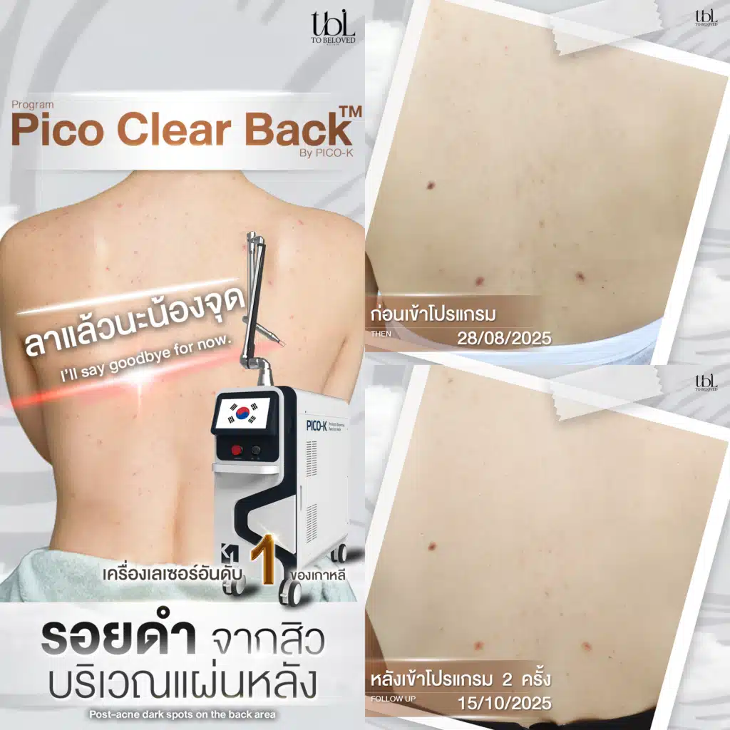 เลเซอร์รอยสิวที่หลัง