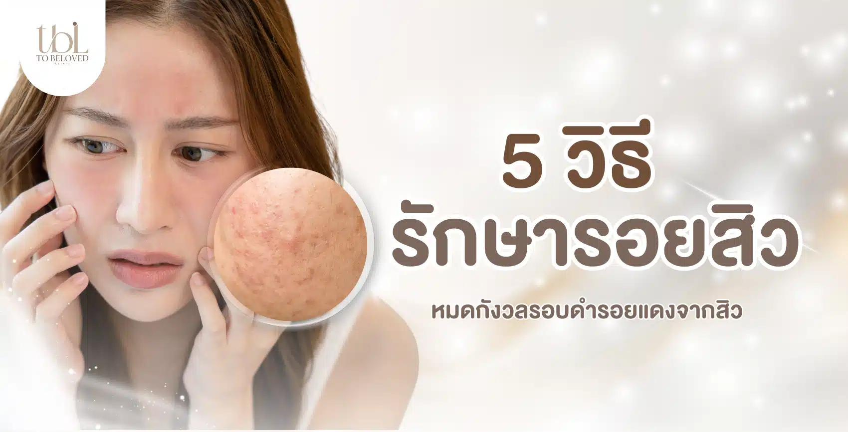 รักษารอยสิว รักษารอยสิว