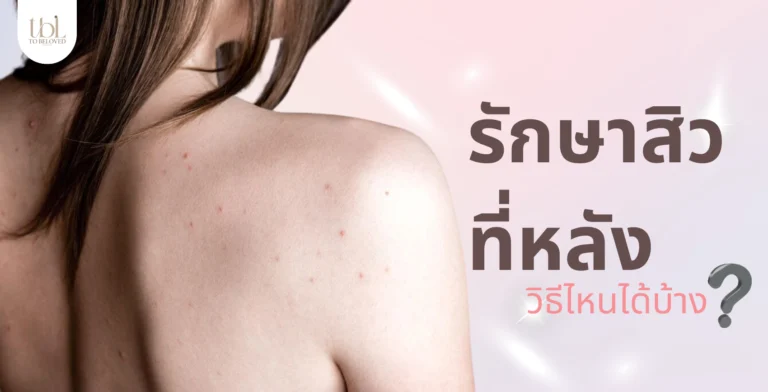 รักษาสิวที่หลัง