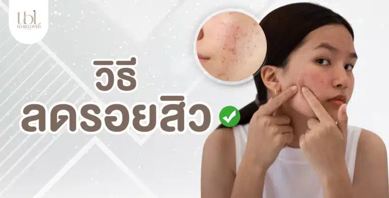 ลดรอยสิว