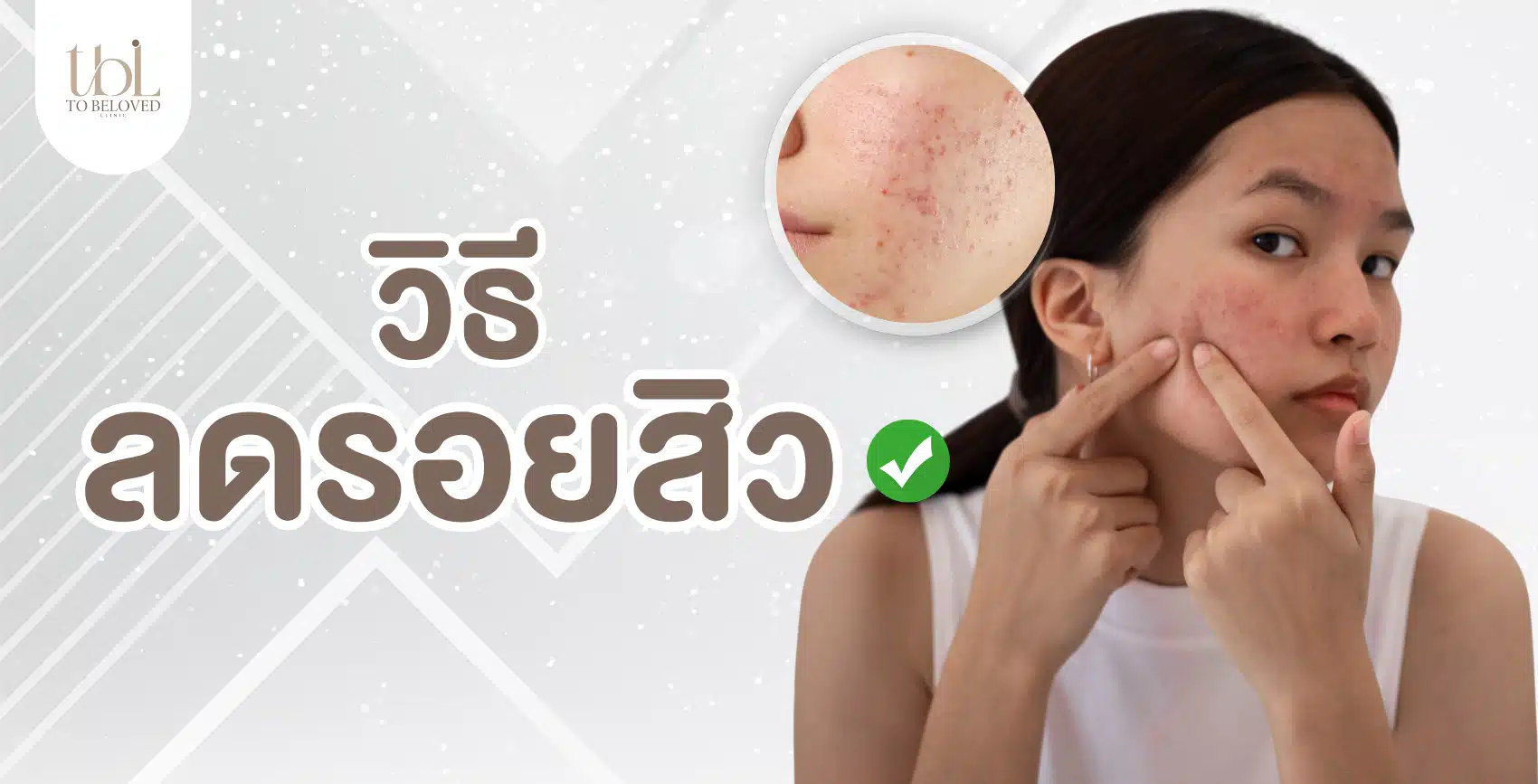 ลดรอยสิว ลดรอยสิว