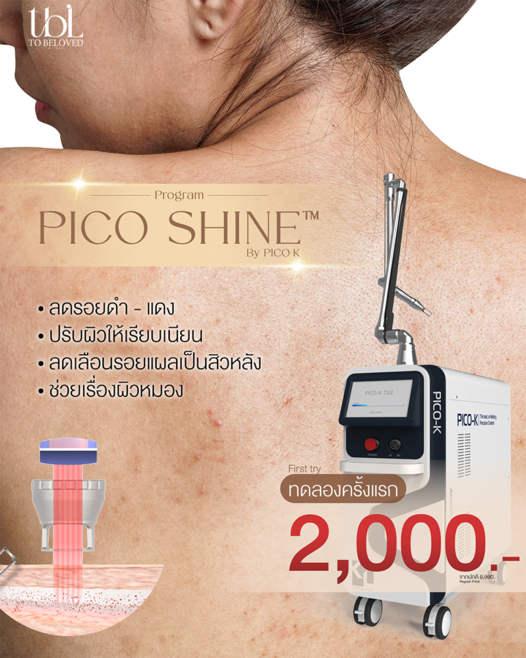 เลเซอร์สิวหลัง