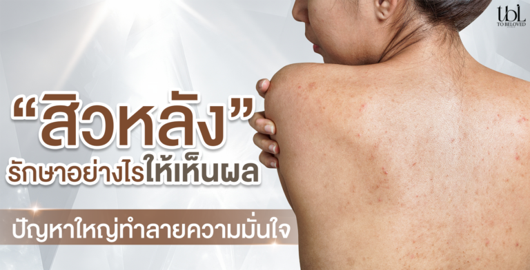 เลเซอร์รอยสิวที่หลัง