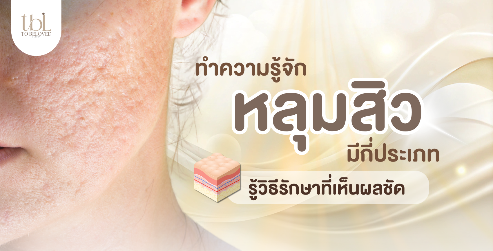 หลุมสิว หลุมสิว