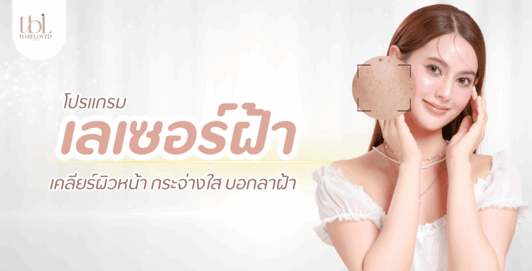 เลเซอร์ฝ้า