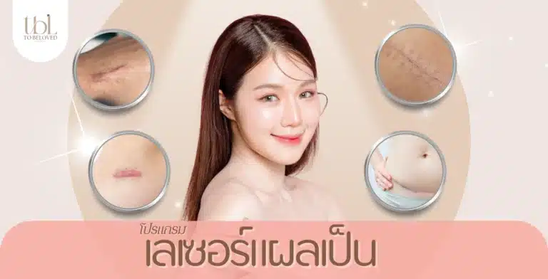 เลเซอร์แผลเป็น