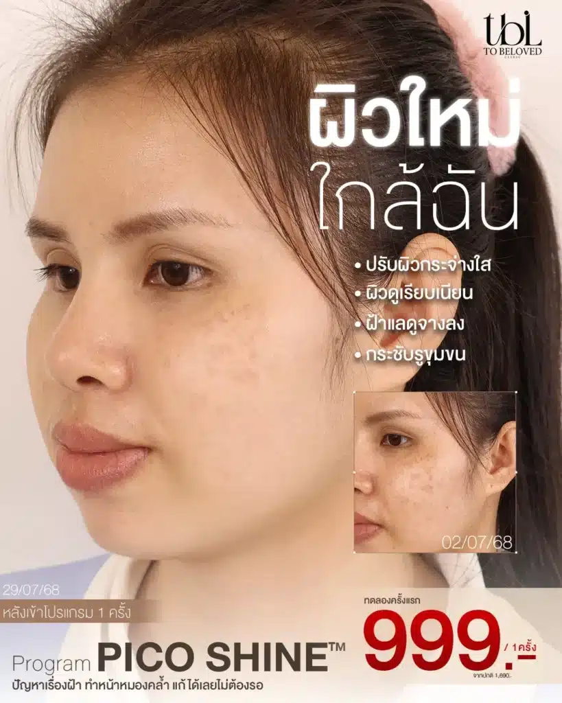 รีวิว Pico Laser ฝ้า